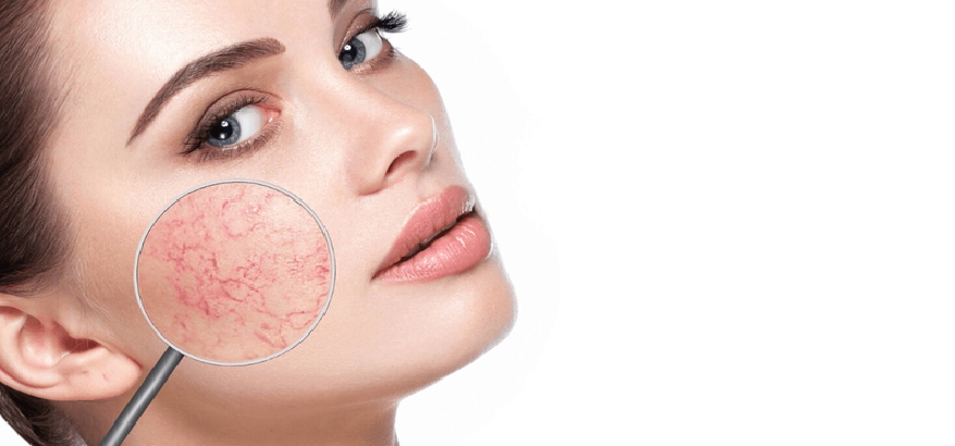 Apa Itu Spider Vein dan Bagaimana cara Menghilangkannya? Konsultasikan di AFK Beauty Skincare